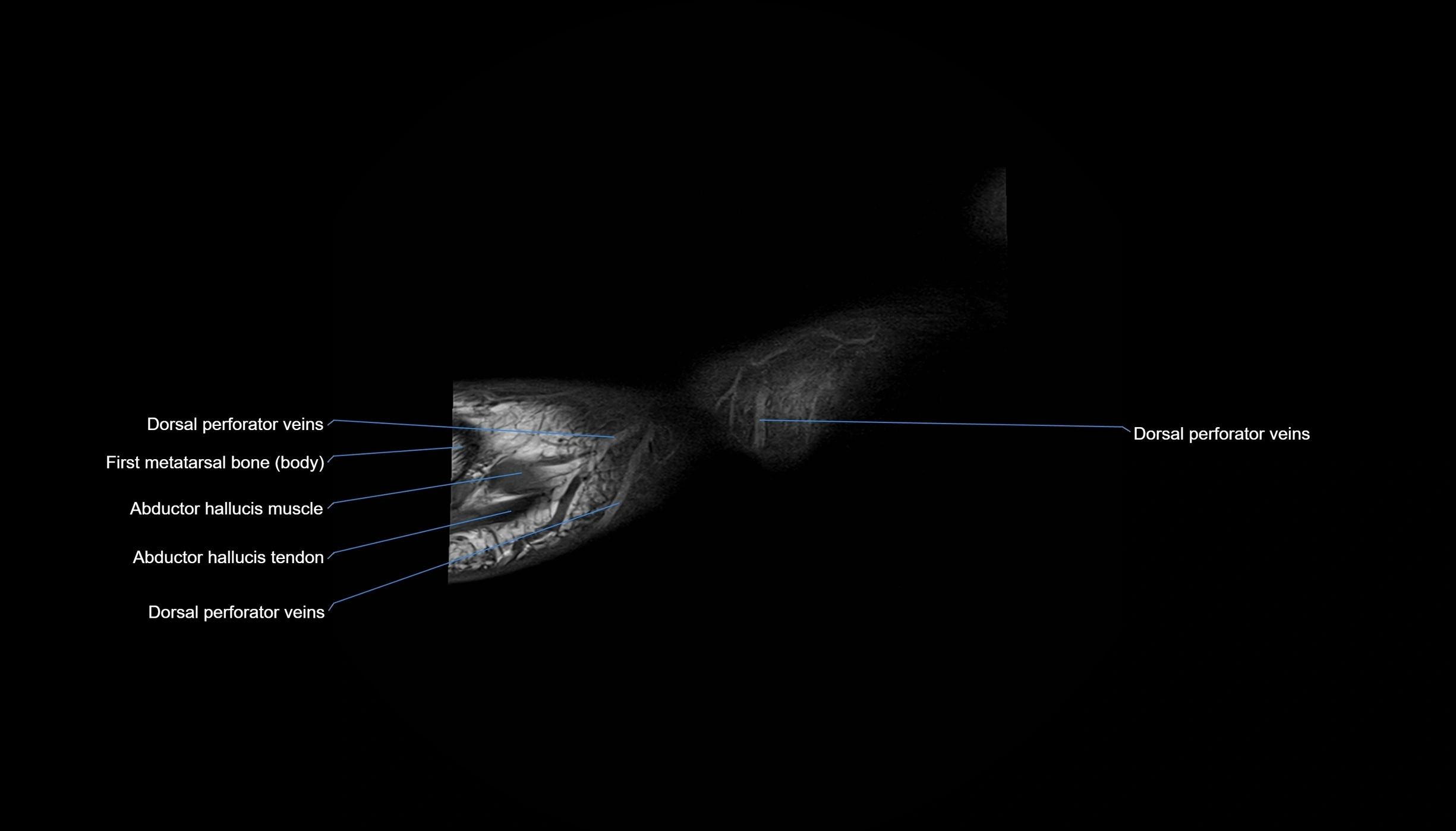 MRI mid foot sagittal cross sectional anatomy 3T  radiology  image-img-00001-00041.webp